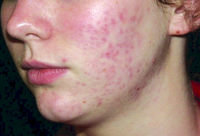 radiofrequenza viso acne