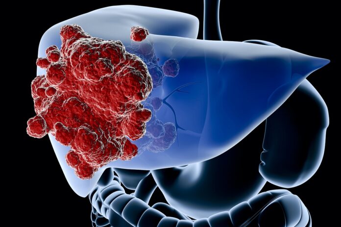 A diagram showing the liver in blue and a cancer in red